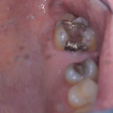 Fillings case 02 before