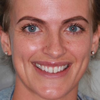 Composite bonding results before